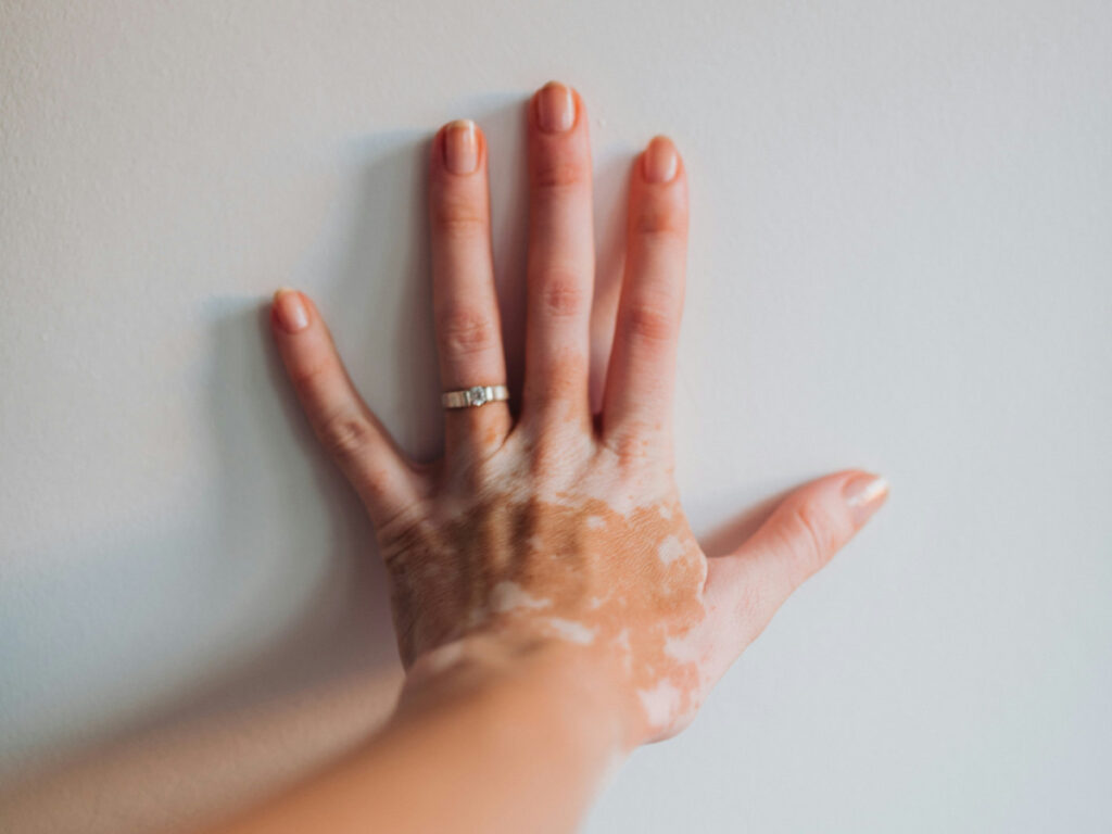 Skin transplant color change explored in new study